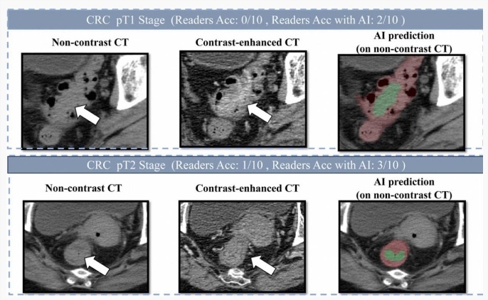 阿里达摩院发布新型肠癌筛查AI模型，助推早筛更精准-爱智特agent,一站式企业智能体推荐平台,扣子企业智能体,扣子工作流免费复制下载
